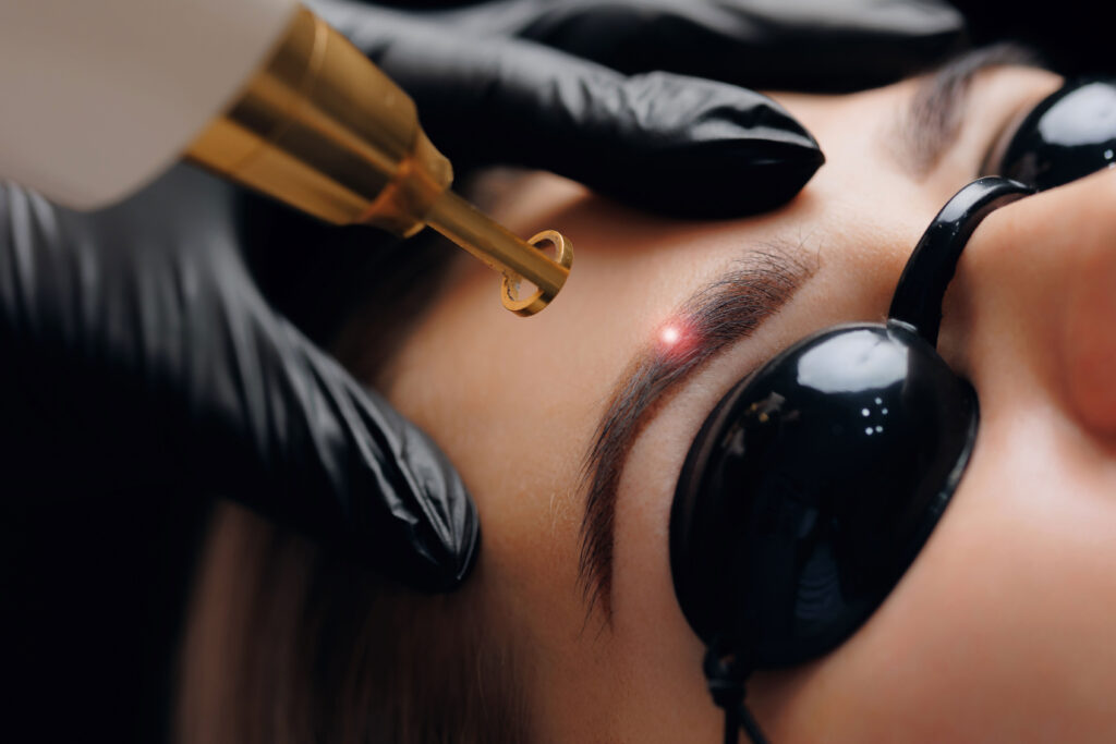 Entfernung von Permanent-Make-up mit dem Pikosekundenlaser